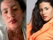 Síndrome de Stevens-Johnson: conheça a doença que afetou mulher de Frank Aguiar