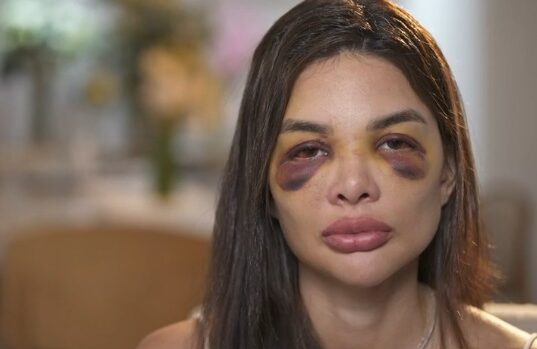 Dentista relata ao ‘Fantástico’ agressões que sofreu do marido, empresário da Faria Lima